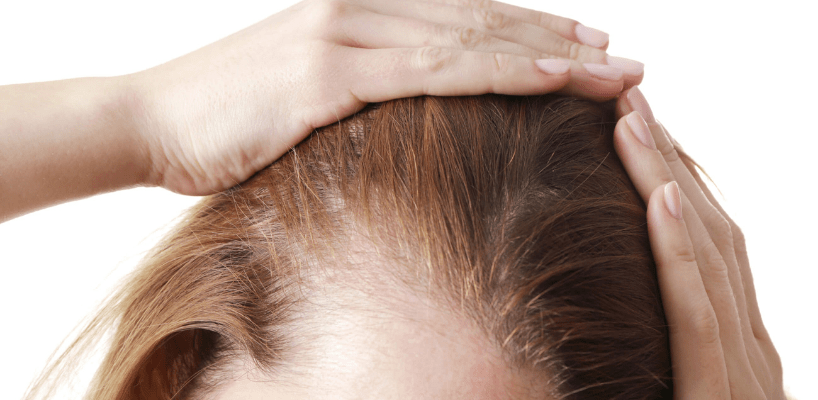 زراعة الشعر للسيدات