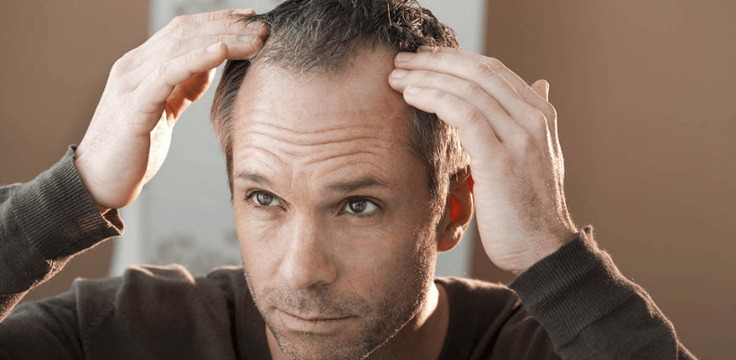 تساقط الشّعر الأسباب والعلاج | ClinicExpert خدمات زراعة الشعر والرعاية  الصحية الدولية