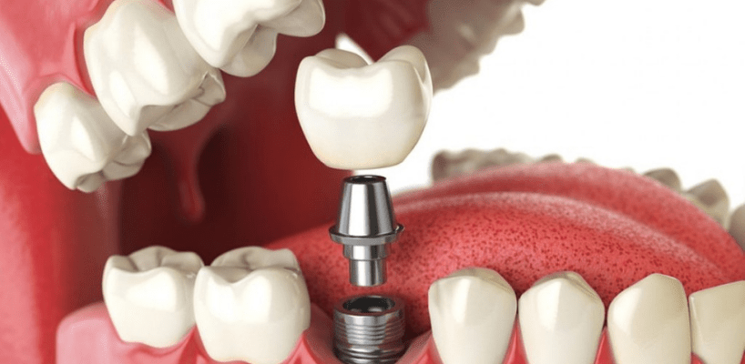 زراعة الأسنان