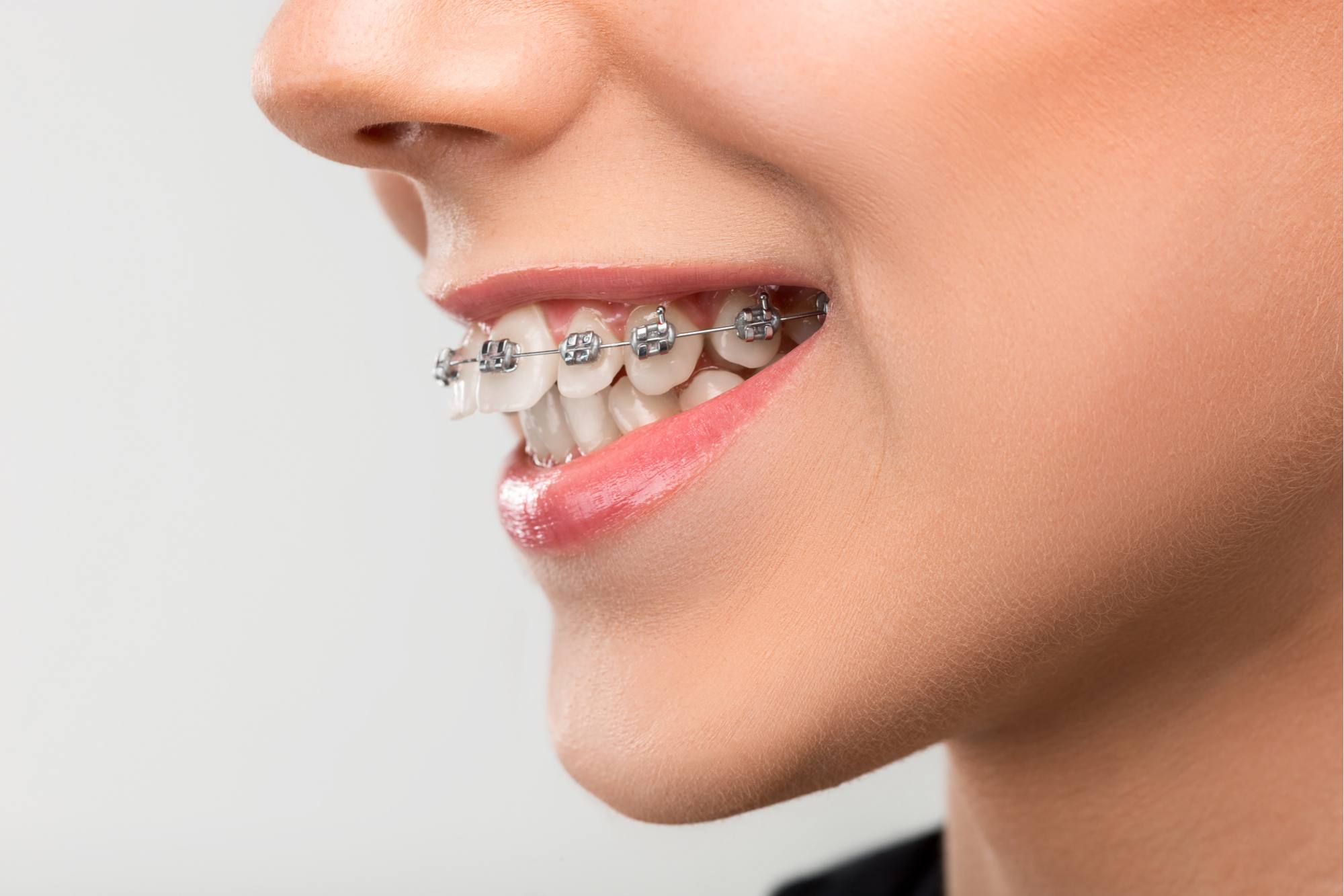 جراحة تعديل الأسنان البارزة