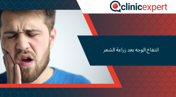 انتفاخ الوجه بعد زراعة الشعر