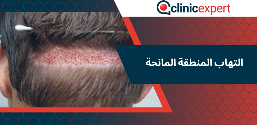 التهاب المنطقة المانحة