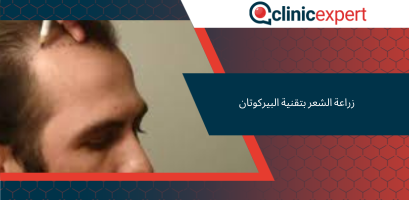 زراعة الشعر بتقنية البيركوتان