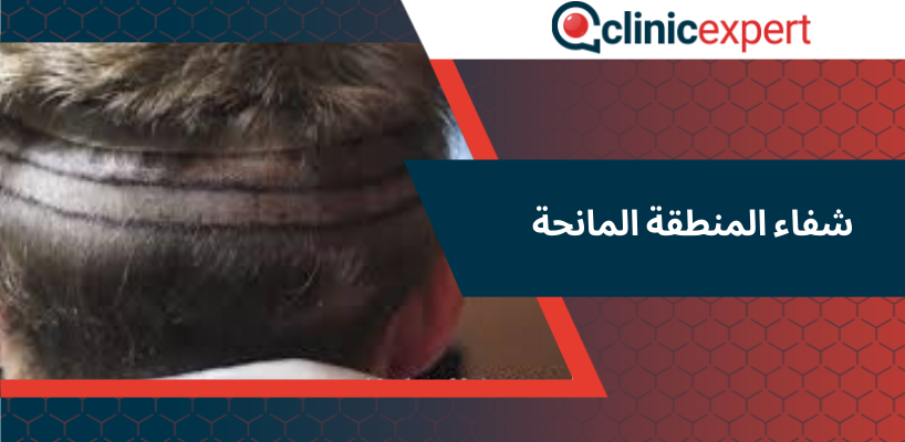 شفاء المنطقة المانحة