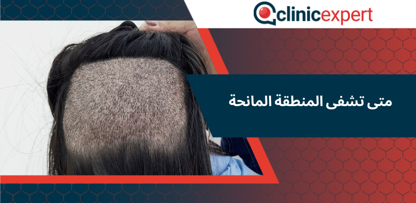 متى تشفى المنطقة المانحة