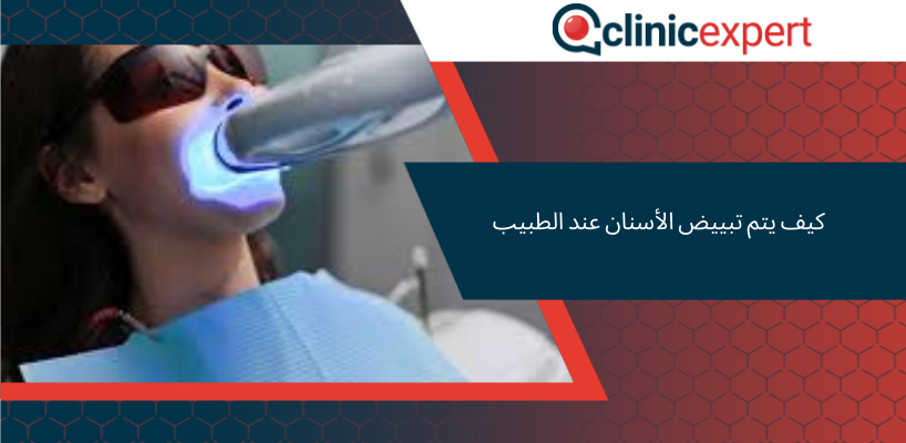 تبييض الأسنان عند الطبيب