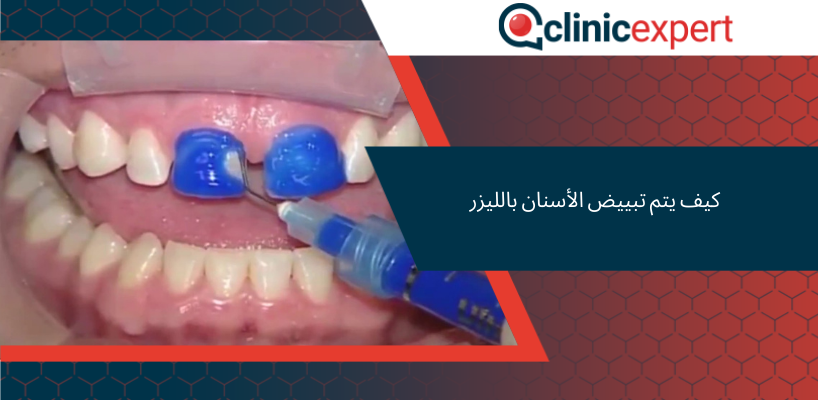 كيف يتم تبييض الأسنان بالليزر