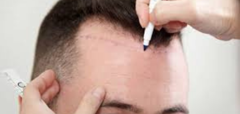 أحدث زراعة شعر