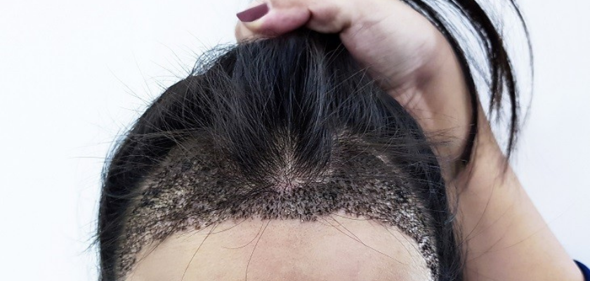 زراعة الشعر بدون حلاقة