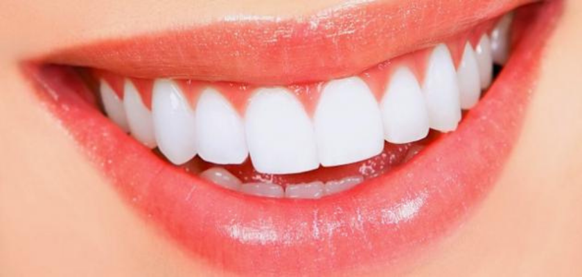 تجمیل الأسنان بدون نحت