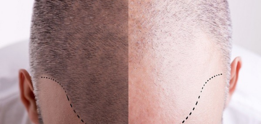 زراعة الشعر في اسطنبول