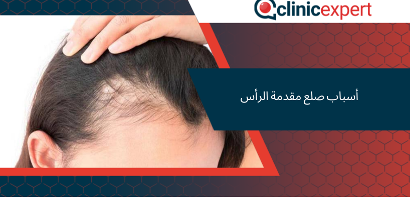 أسباب صلع مقدمة الرأس