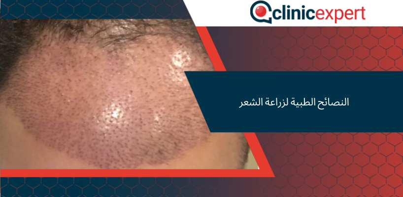 النصائح الطبية لزراعة الشعر