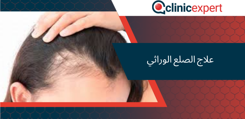 علاج الصلع الوراثي