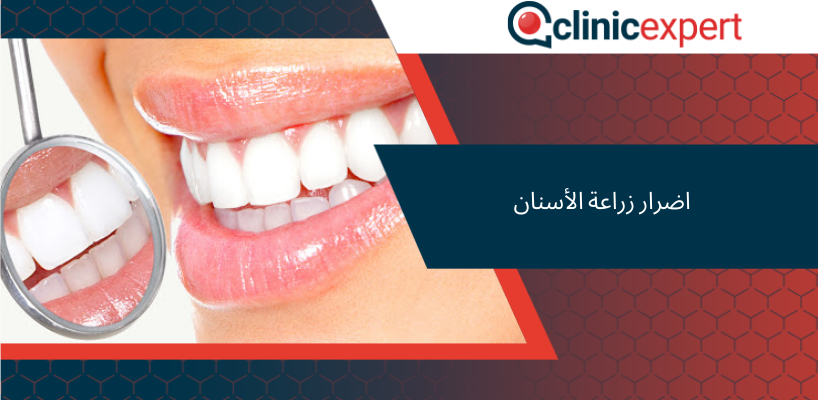 اضرار زراعة الأسنان