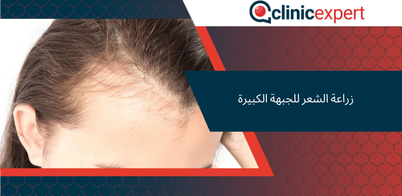 زراعة الشعر للجبهة الكبيرة