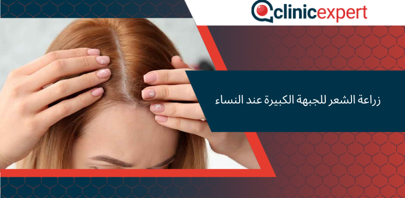 زراعة الشعر للجبهة الكبيرة عند النساء