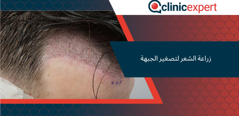زراعة الشعر لتصغير الجبهة
