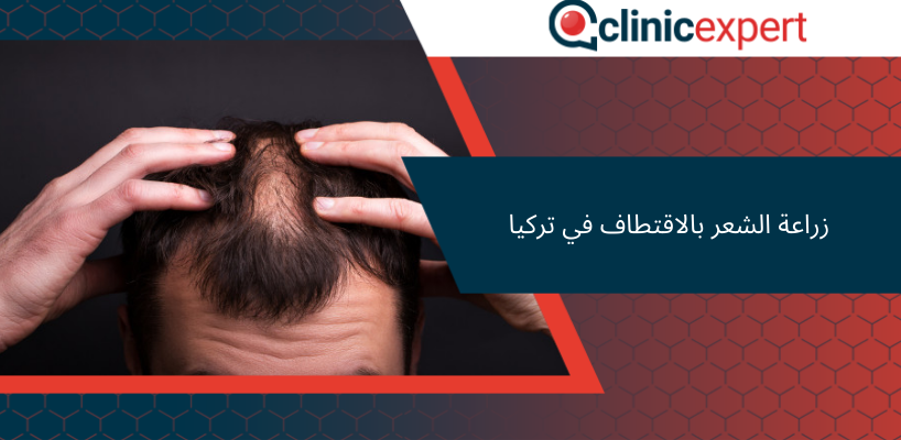 زراعة الشعر بالاقتطاف في تركيا