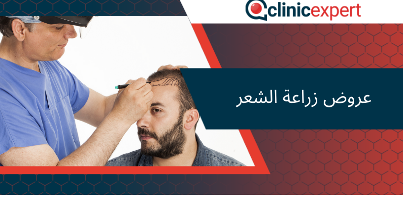عروض زراعة الشعر