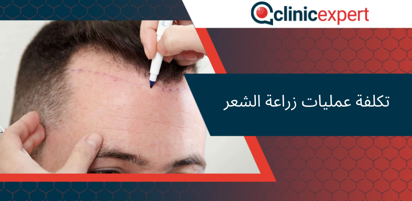  تكلفة عمليات زراعة الشعر