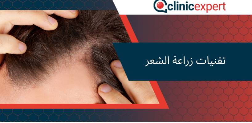 تقنيات زراعة الشعر