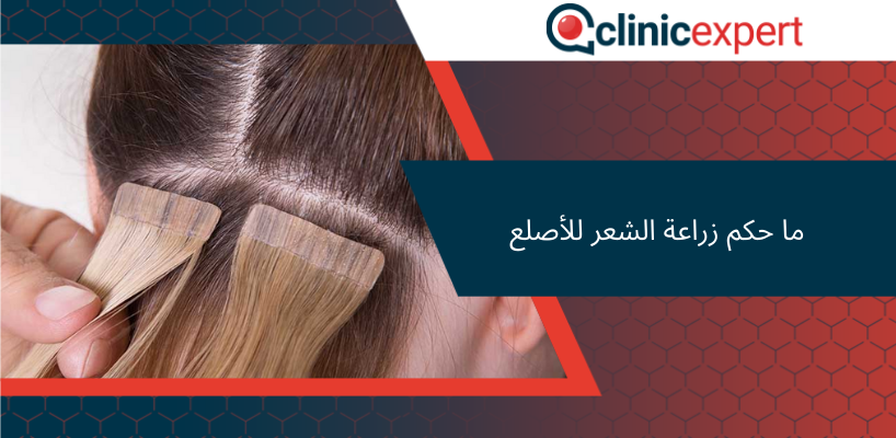 ما حكم زراعة الشعر للأصلع