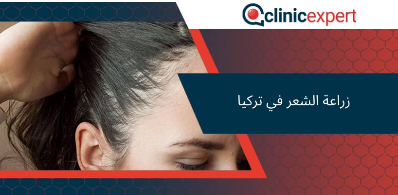 زراعة الشعر في تركيا