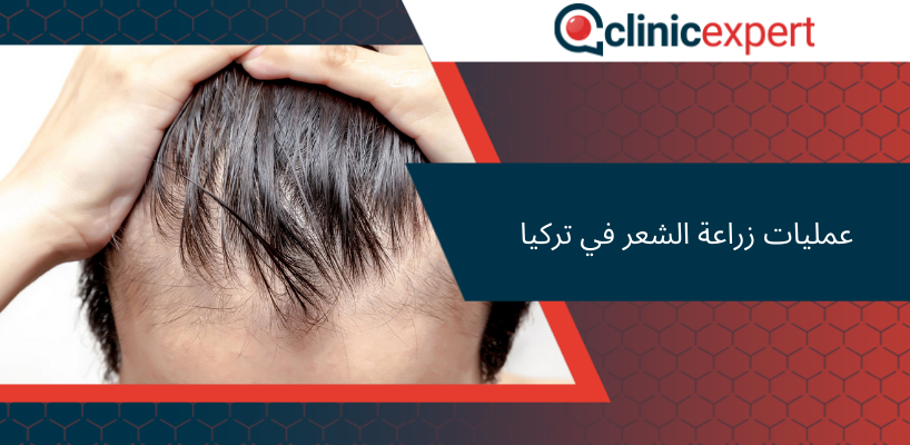 عمليات زراعة الشعر في تركيا