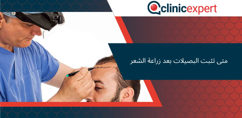 متى تثبت البصيلات بعد زراعة الشعر