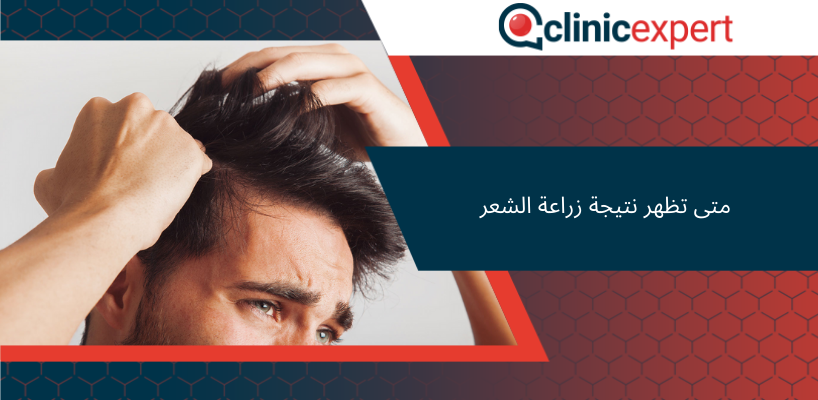 متى تظهر نتيجة زراعة الشعر