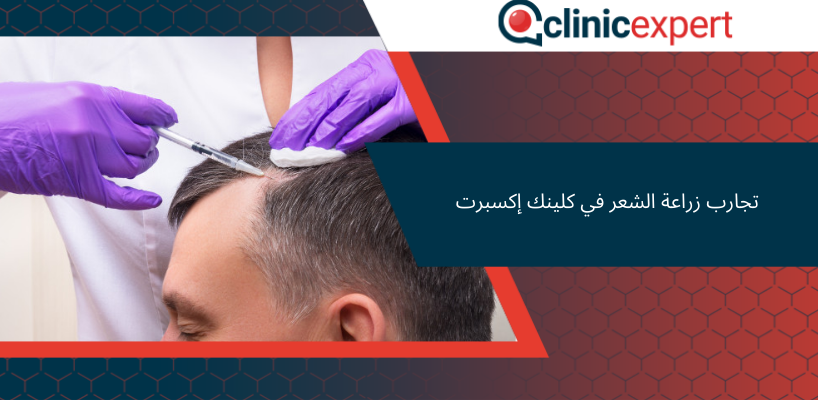 تجارب زراعة الشعر