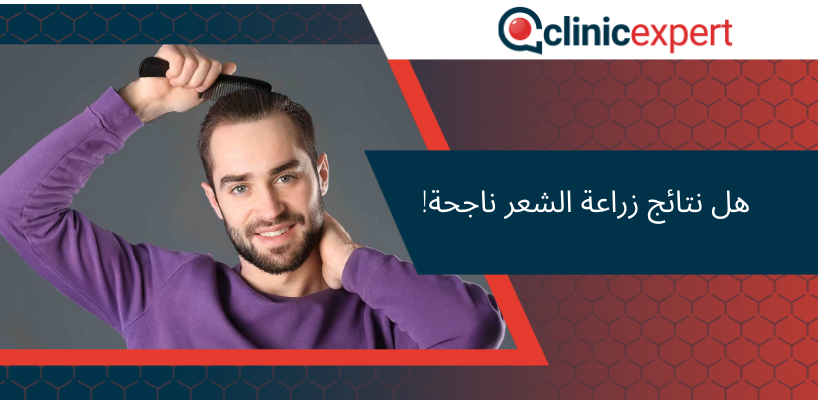 هل نتائج زراعة الشعر ناجحة