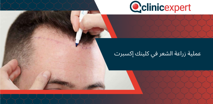 عملية زراعة الشعر في كلينك إكسبرت