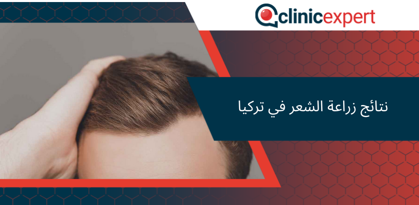  نتائج زراعة الشعر في تركيا