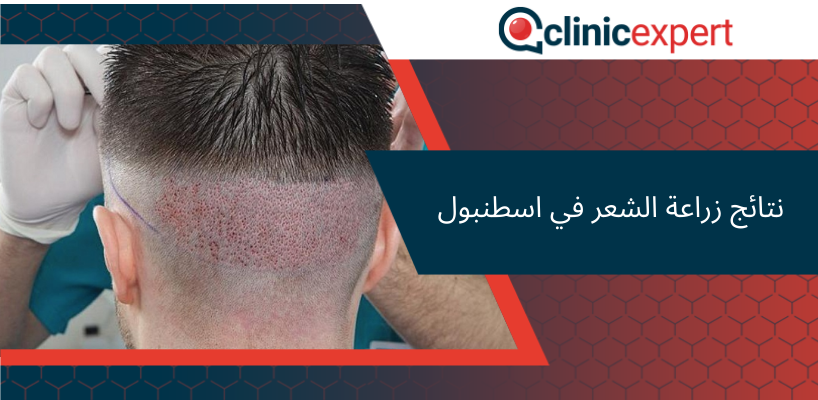  نتائج زراعة الشعر في اسطنبول