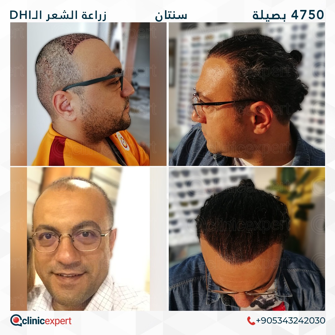 زراعة الشعر- 24 اشهر- 4750 بصيلة