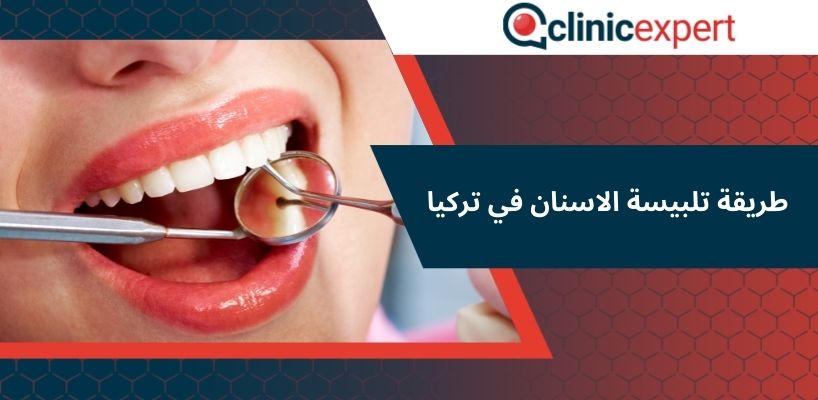 طريقة تلبيسة الاسنان في تركيا