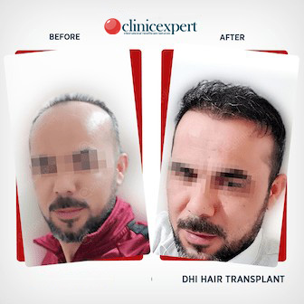 DHI Hair Transplant Patient-before and after