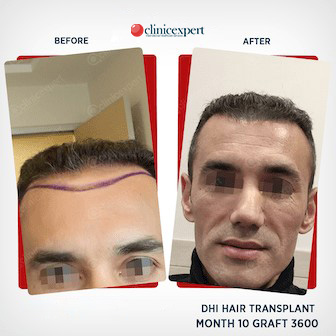 DHI Hair Transplant - 10 Months- 3600 Grafts