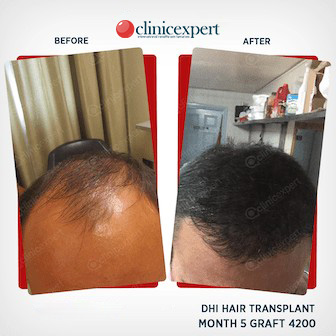 DHI Hair Transplant - 5 Months- 4200 Grafts