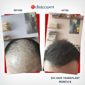 DHI Hair Transplant-8 Months Results