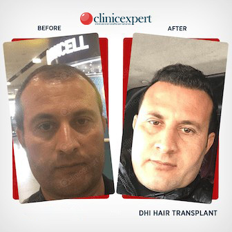 Hair Transplant Results- DHI- Before and After