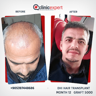 DHI Hair Transplant - 12 Months - 5000 Grafts