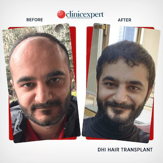 Results-DHI- Hair Transplant