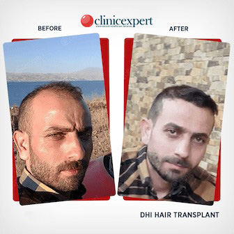 Result-Hair Transplant-DHI