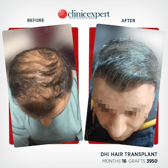DHI Hair Transplant-16 months- 3950 Grafts
