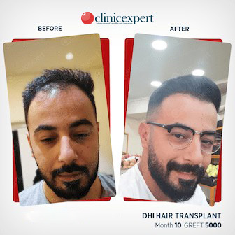 DHI Hair Transplant- 10 Months - 5000 Grafts