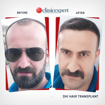 Before and after DHI Hair Transplant