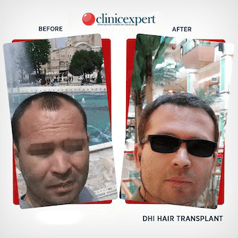 DHI Hair transplant Before and After